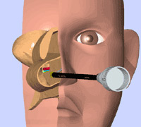粘膜下下甲介骨切除術＋粘膜下後鼻神経凍結術