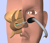 粘膜下下甲介骨切除術＋後鼻神経切除術