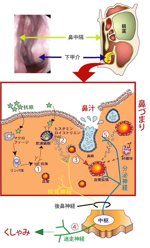 アレルギー 性 鼻炎 について 正しい の は どれ か