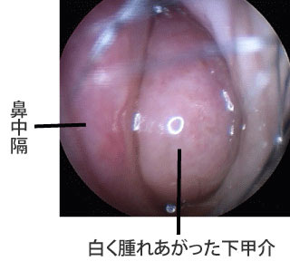 アレルギー性鼻炎