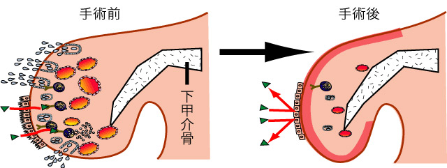 下甲介粘膜焼灼術