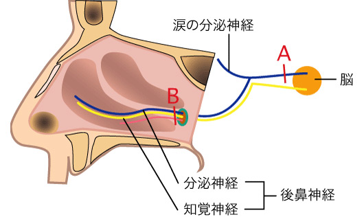 後鼻神経切断手術＋粘膜下下鼻甲介骨切除術