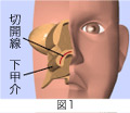 後鼻神経切断手術＋粘膜下下鼻甲介骨切除術