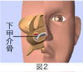 後鼻神経切断手術＋粘膜下下鼻甲介骨切除術