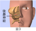 後鼻神経切断手術＋粘膜下下鼻甲介骨切除術