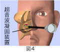 後鼻神経切断手術＋粘膜下下鼻甲介骨切除術