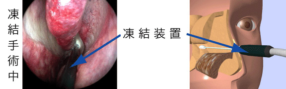 後鼻神経凍結手術