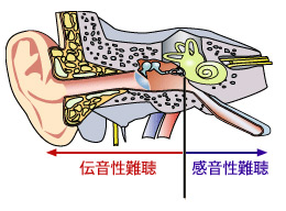 難聴の種類