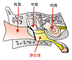 滲出性中耳炎