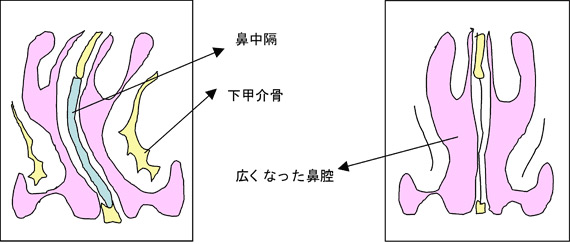 粘膜下下甲介骨切除術