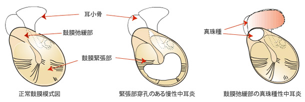 慢性中耳炎