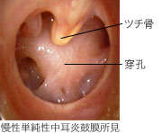 慢性単純性中耳炎