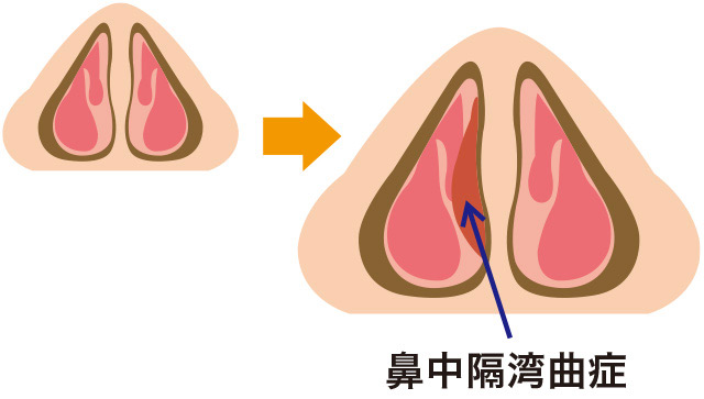 鼻中隔弯曲症の症状と治療について 岩野耳鼻咽喉科