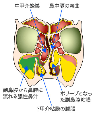 副鼻腔炎 蓄膿症 の症状と治療法について 岩野耳鼻咽喉科