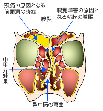 副鼻腔炎