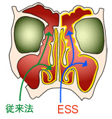 内視鏡下副鼻腔手術