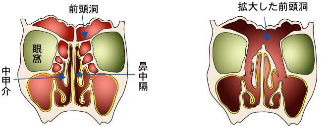 拡大前頭洞手術