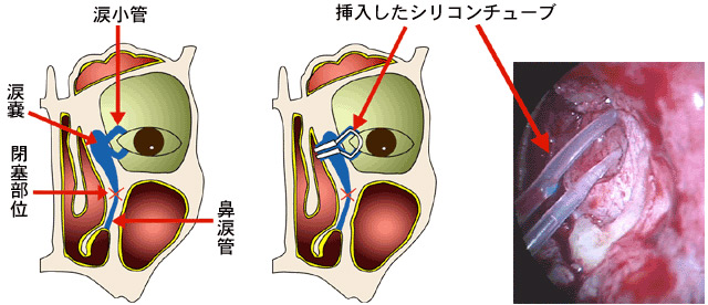 涙嚢鼻腔吻合術