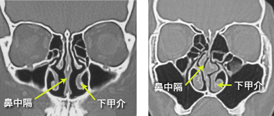 いびき・睡眠時無呼吸症候群の原因