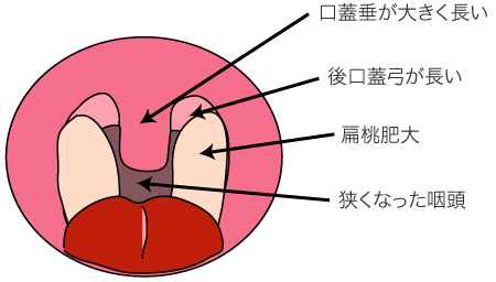 軟口蓋、口蓋垂の形態異常