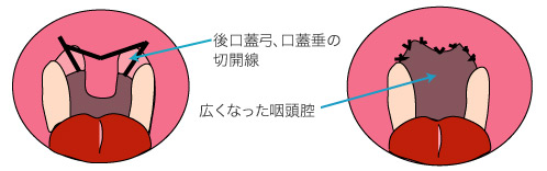 レーザーによる口蓋垂口蓋形成術